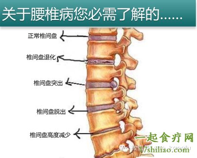 腰椎间盘突出最基本的病因是腰椎间盘的退行性改变